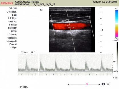 Capture d'images écho-doppler couleur à partir d'un ordinateur PC compatible équipé d’une interface vidéo.